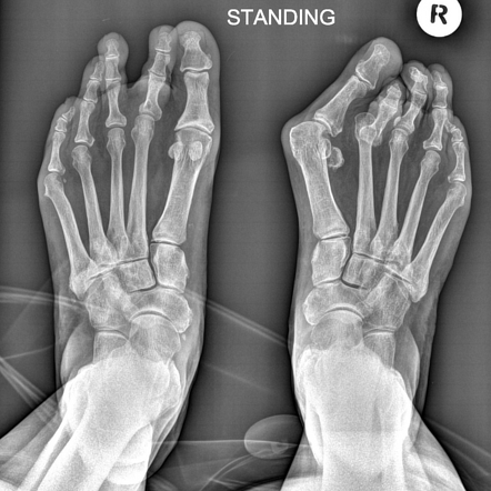 Pes planus | Radiology Reference Article | Radiopaedia.org