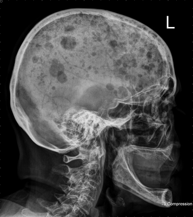 Raindrop skull | Radiology Reference Article | Radiopaedia.org