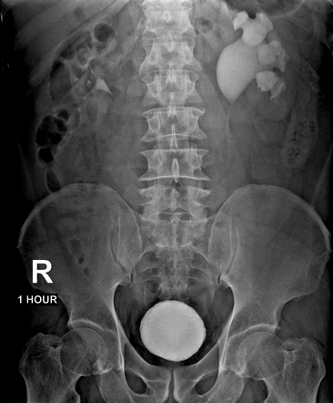 Ureteropelvic Junction Obstruction | Radiology Case | Radiopaedia.org