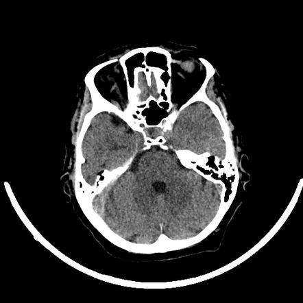 Orbital venous varix | Radiology Case | Radiopaedia.org