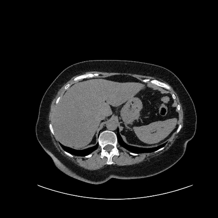 Fat Containing Splenic Lesions | Radiology Reference Article ...