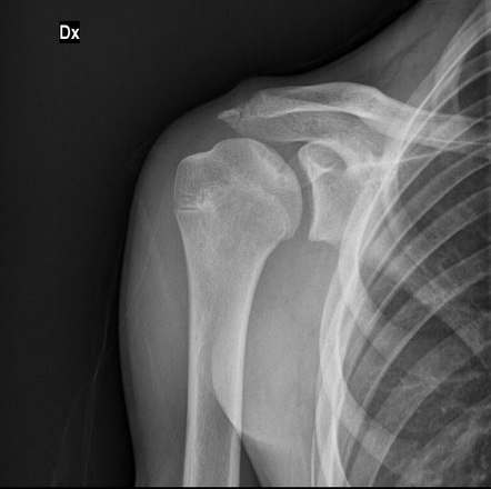 Osteonecrosis of the humeral head | Radiology Reference Article ...