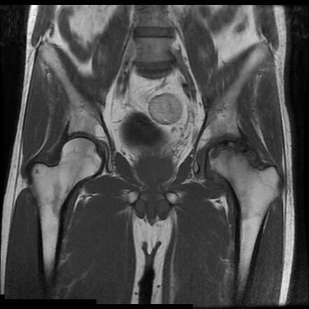 Femoral head avascular necrosis | Radiology Case | Radiopaedia.org