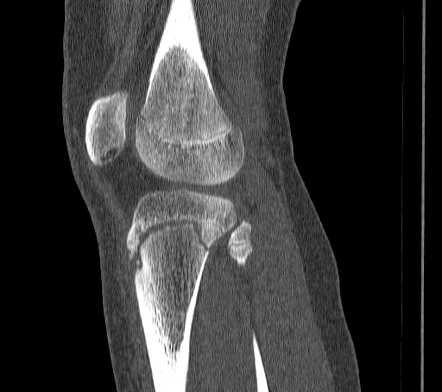 Salter-Harris type II fracture | Radiology Case | Radiopaedia.org