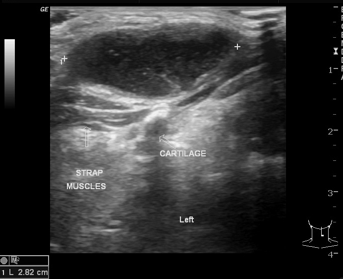 Thyroglossal Duct Cyst Ultrasound Images