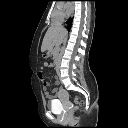 Vesicovaginal fistula | Radiology Reference Article | Radiopaedia.org