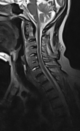 Diffuse idiopathic skeletal hyperostosis (DISH) | Radiology Case ...