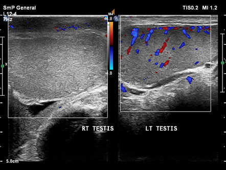 Post traumatic acute testicular torsion | Radiology Case | Radiopaedia.org