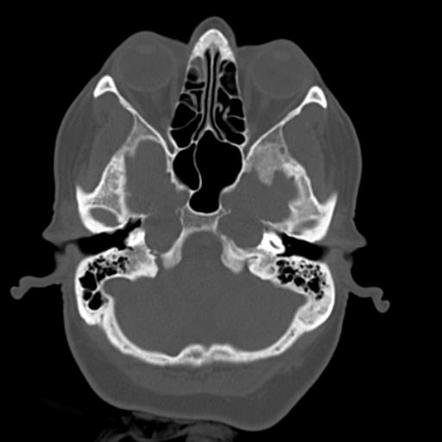 Petrous apex cephalocele | Radiology Reference Article | Radiopaedia.org