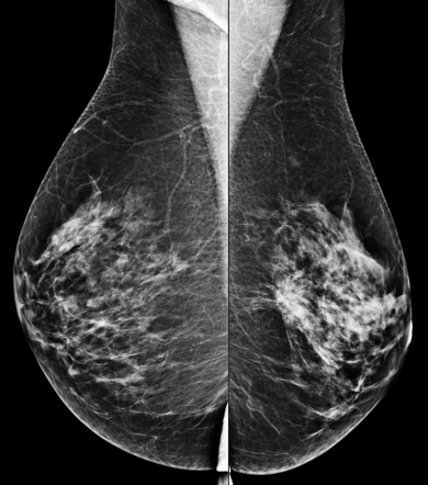 Breast Imaging-reporting And Data System (BI-RADS) Assessment Category ...