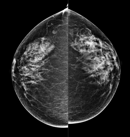 Breast imaging-reporting and data system (BI-RADS) assessment category ...