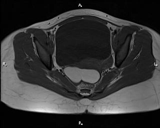 Endometrioma | Radiology Reference Article | Radiopaedia.org