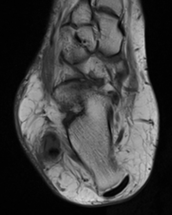 Split tear of the peroneus brevis tendon | Radiology Case | Radiopaedia.org