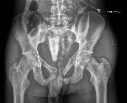 Pelvic fractures with intraperitoneal bladder rupture | Radiology Case ...