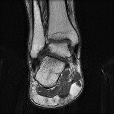 Ankle ganglion cysts | Radiology Case | Radiopaedia.org