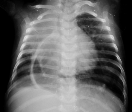 Scimitar syndrome | Radiology Case | Radiopaedia.org