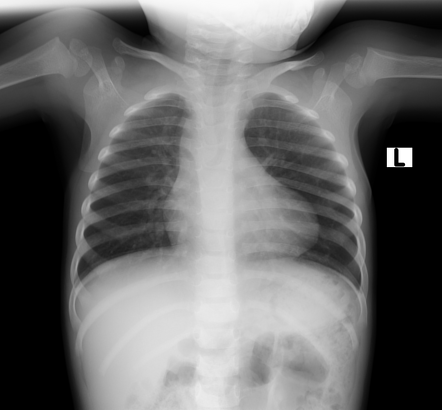 tetralogy of fallot case study