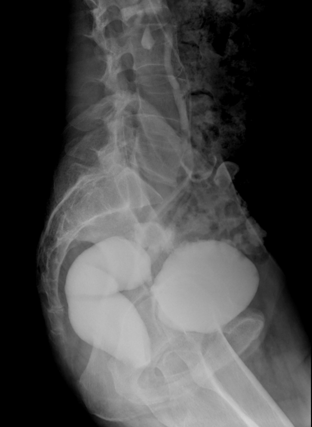 File:Colovesical fistula due to diverticulitis (Radiopaedia 171094 ...