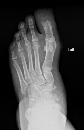 Osteomyelitis and avulsion fracture in a diabetic foot | Radiology Case ...