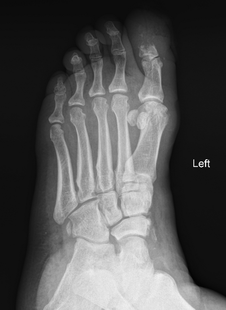 pie hueso anatomía cuboides fx