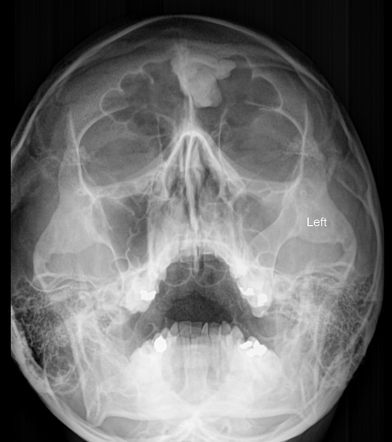 Paranasal sinus osteoma | Radiology Reference Article | Radiopaedia.org