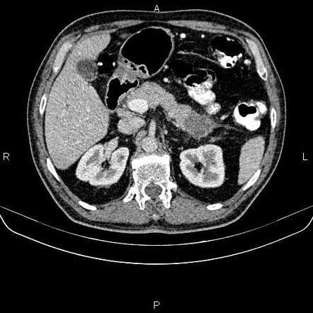 Metastatic pancreatic tail ductal adenocarcinoma | Radiology Case ...