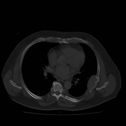 Solitary bone plasmacytoma | Radiology Reference Article | Radiopaedia.org