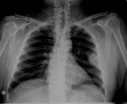 Solitary bone plasmacytoma | radiology case | radiopaedia.org