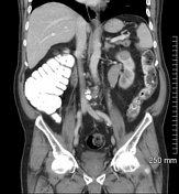 icd 10 code papillary renal cell carcinoma