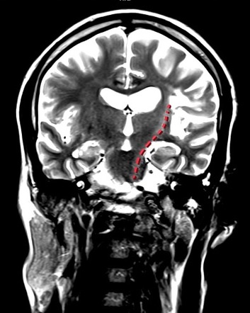 Wallerian degeneration | Radiology Reference Article | Radiopaedia.org