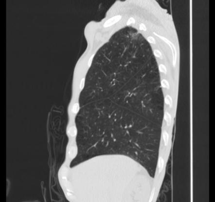 Superior accessory fissure | Radiology Reference Article | Radiopaedia.org