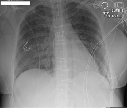 Intra-aortic balloon pump | Radiology Case | Radiopaedia.org