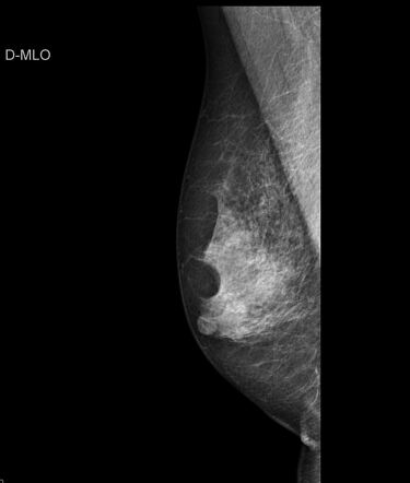 Small breast cancer, Radiology Case