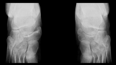 Accessory navicular bone | Radiology Case | Radiopaedia.org