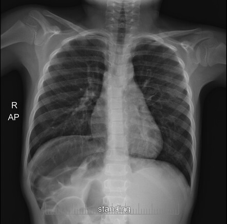 Situs inversus | Radiology Reference Article | Radiopaedia.org