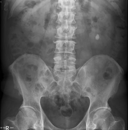 Abdomen (KUB view) | Radiology Reference Article | Radiopaedia.org