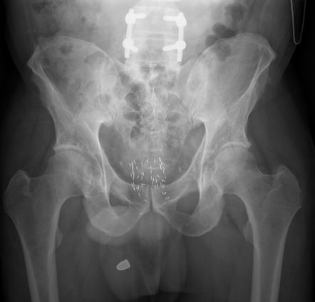 Brachytherapy seed migration | Radiology Case | Radiopaedia.org