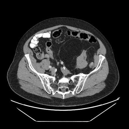 Liposarcoma Pathophysiology Wikidoc