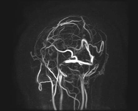 Superior sagittal sinus thrombosis | Radiology Case | Radiopaedia.org