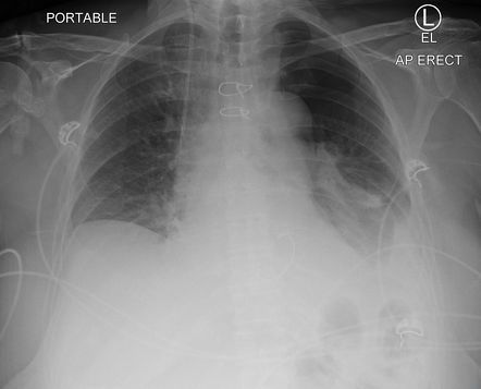 Pneumothorax | Radiology Case | Radiopaedia.org