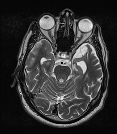 frontotemporal lobar degeneration case study