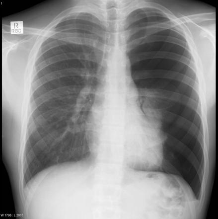 Playlist 'Important chest xray for emergency board exam ' by Dr Maryam ...