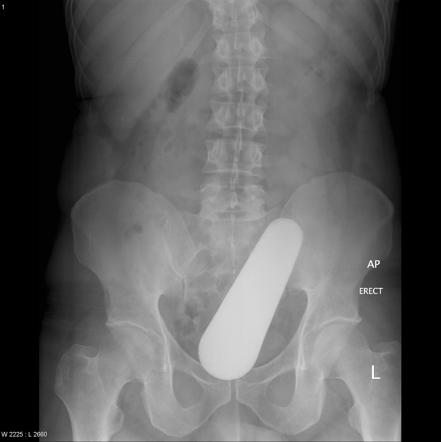 Rectal foreign bodies | Radiology Reference Article | Radiopaedia.org