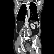 polysplenia | Search | Radiopaedia.org