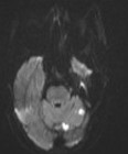 Wall-eyed bilateral internuclear ophthalmoplegia (WEBINO) - midbrain ...