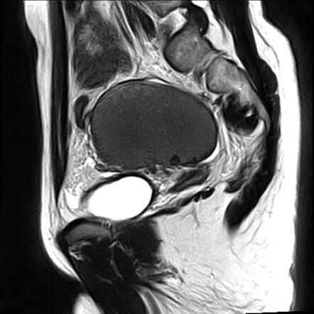 Large ovarian endometrioma | Radiology Case | Radiopaedia.org