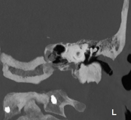 Ossicular chain disruption | Radiology Reference Article | Radiopaedia.org