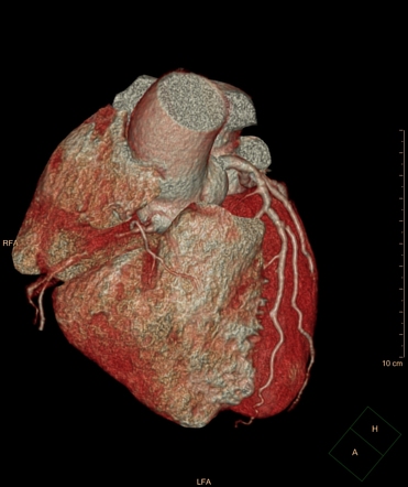 Multivessel coronary artery disease | Radiology Case | Radiopaedia.org