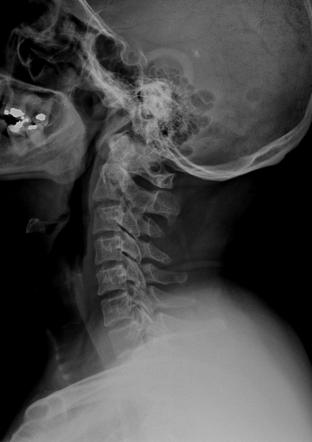 Arcuate foramen | Radiology Case | Radiopaedia.org