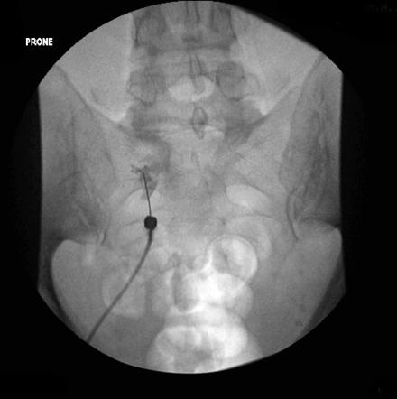 Sacral Foramen Fluoroscopy